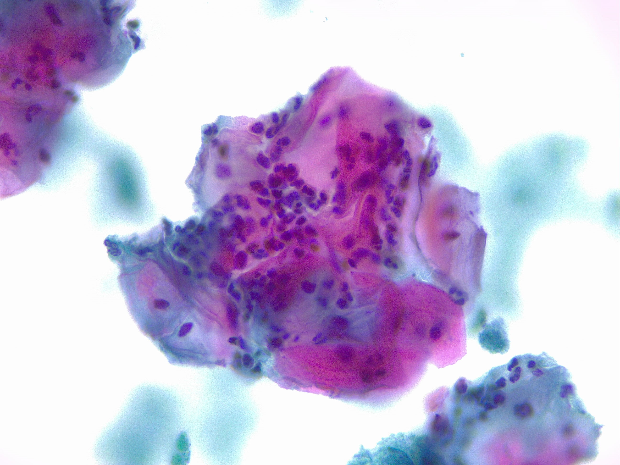 <p>Squamous Cells, Acute Inflammation. Cytology, papanicolaou stain 40x magnification.</p>