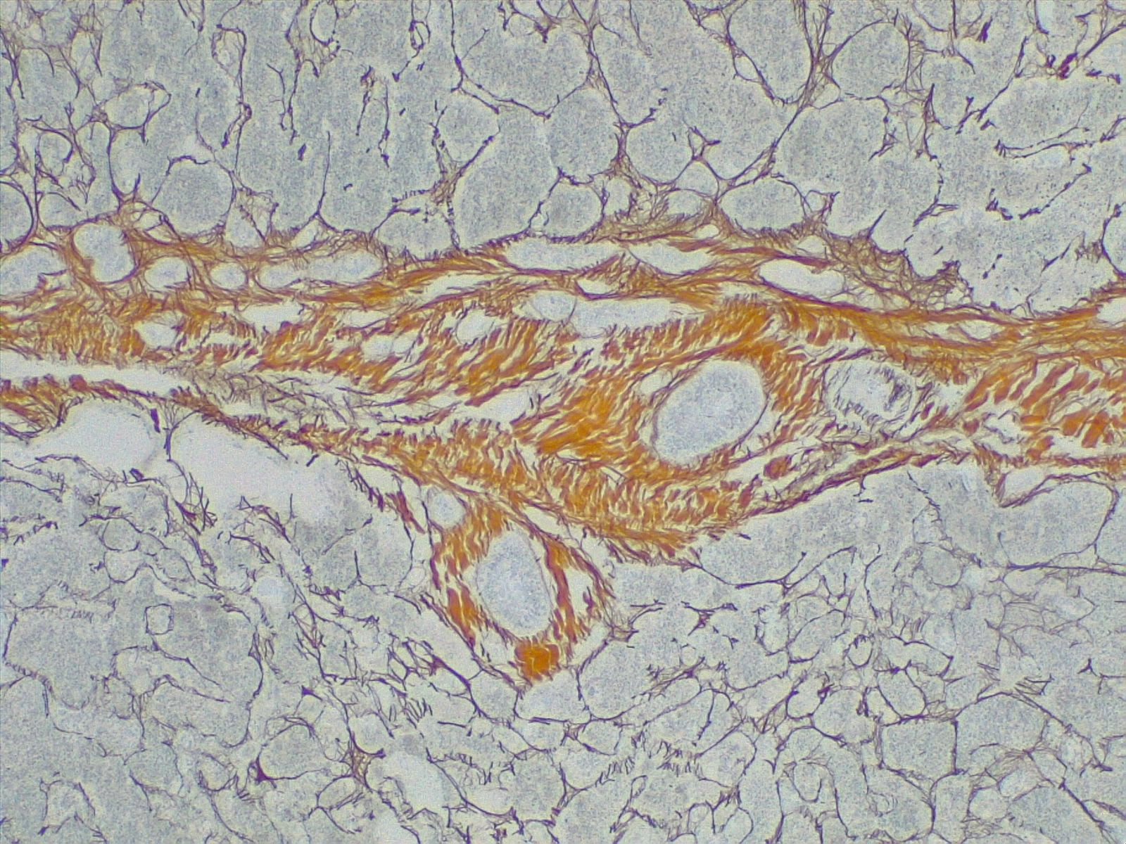 Cirrhosis, portal space in fibrous septa. Reticulin stain 4x