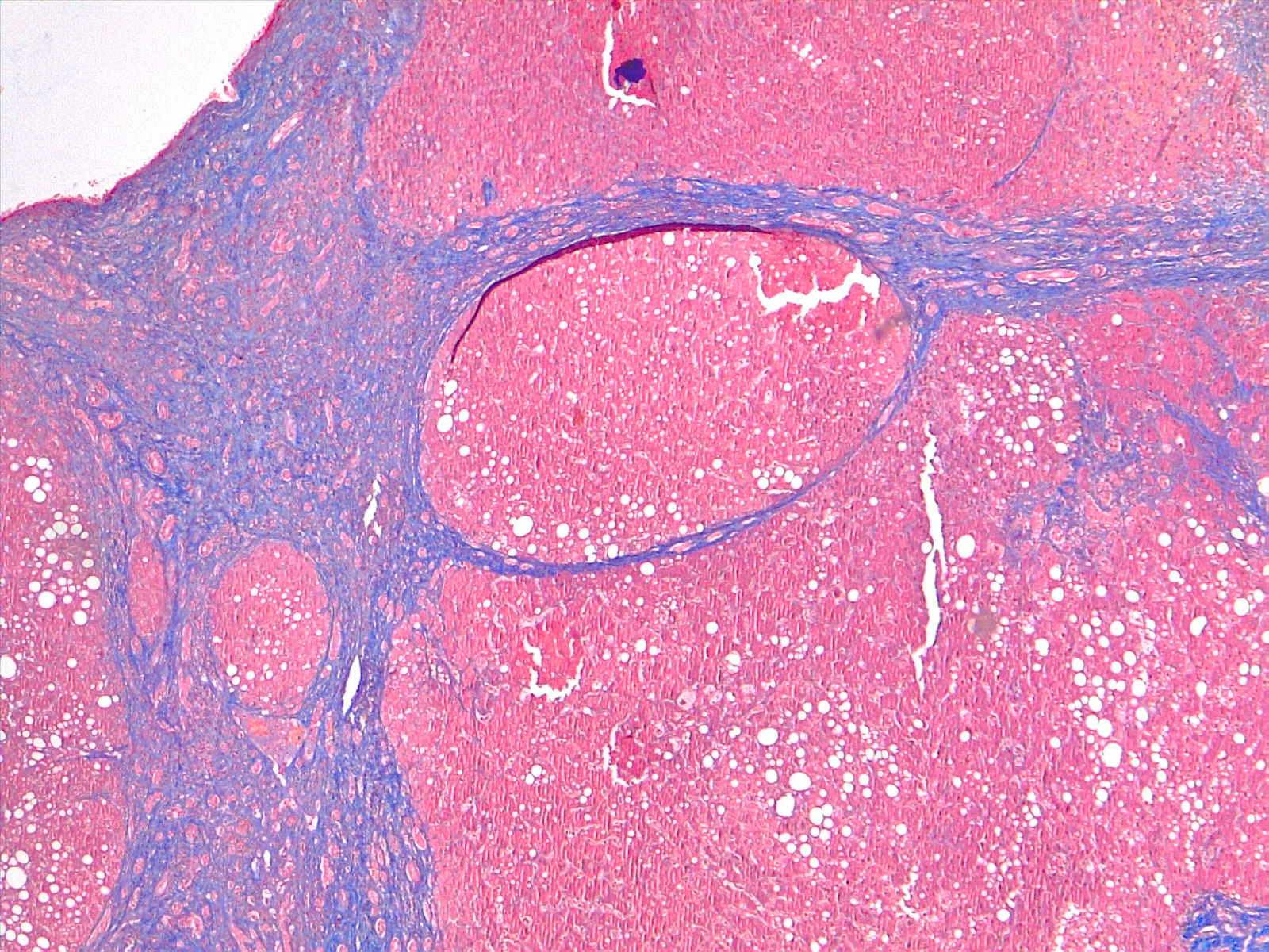 Liver cirrhosis, tricromic stain 4x