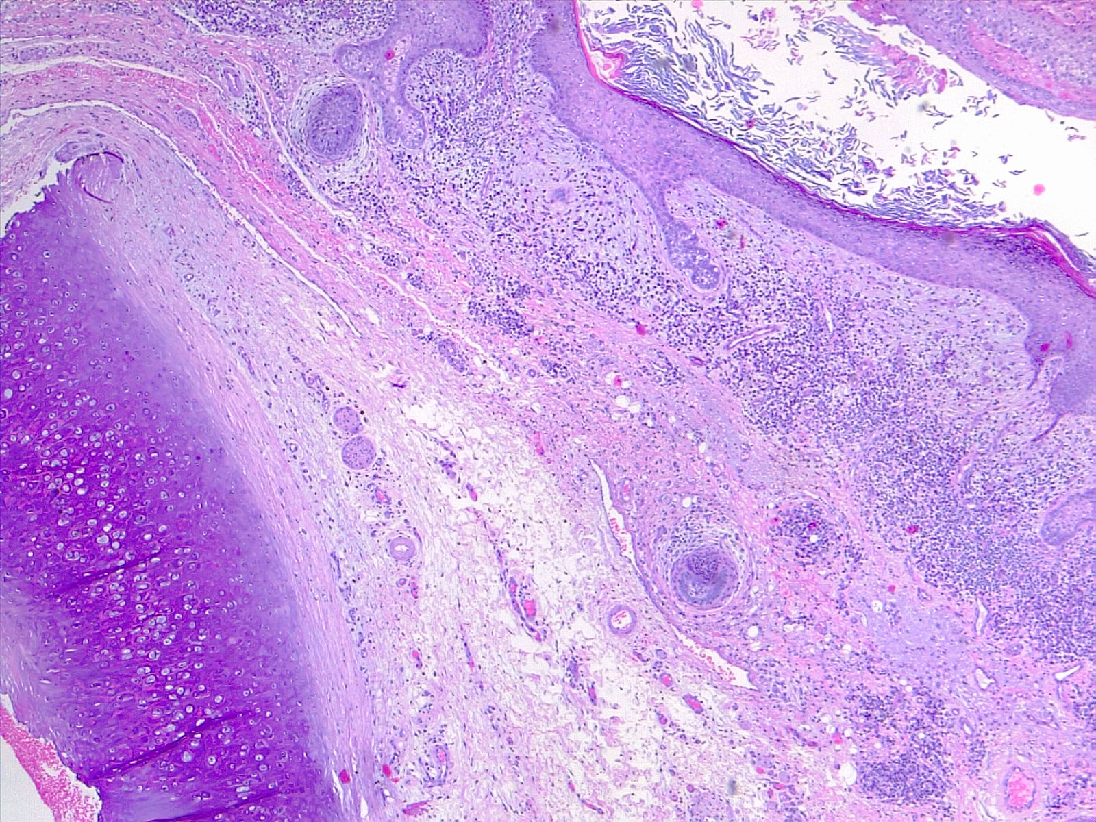 <p>Earlobe, Cartilage, Soft Tissue, and Cutis of the External Ear. H/E 4x magnification.</p>