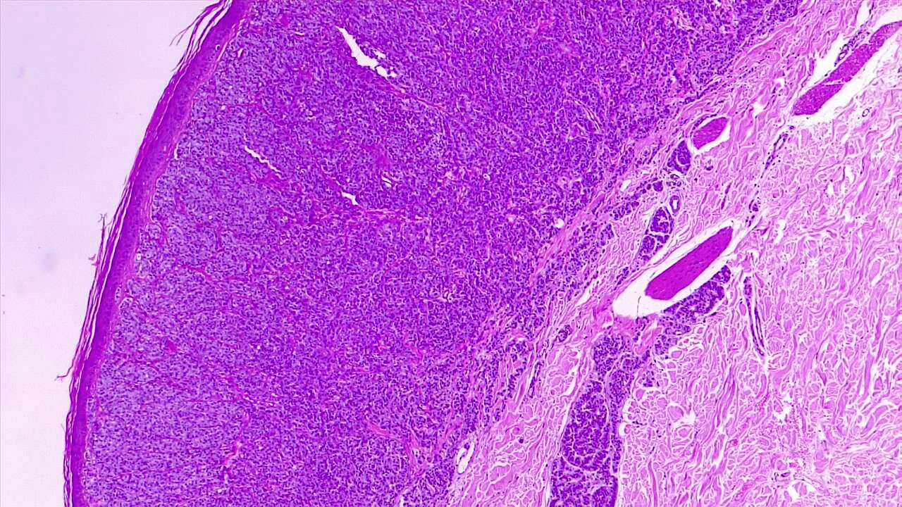<p>Nodular Melanoma. Nodular melanoma with vertical growth phase and deep dermal invasion. H/E 4x</p>