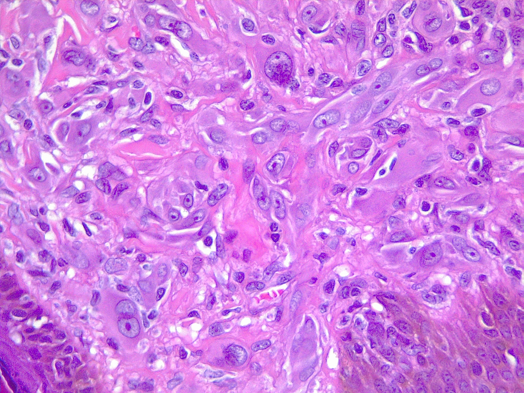 <p>Spitz Melanoma of the Skin. Highly atypical melanocytes in the dermic component. H/E 20x.</p>