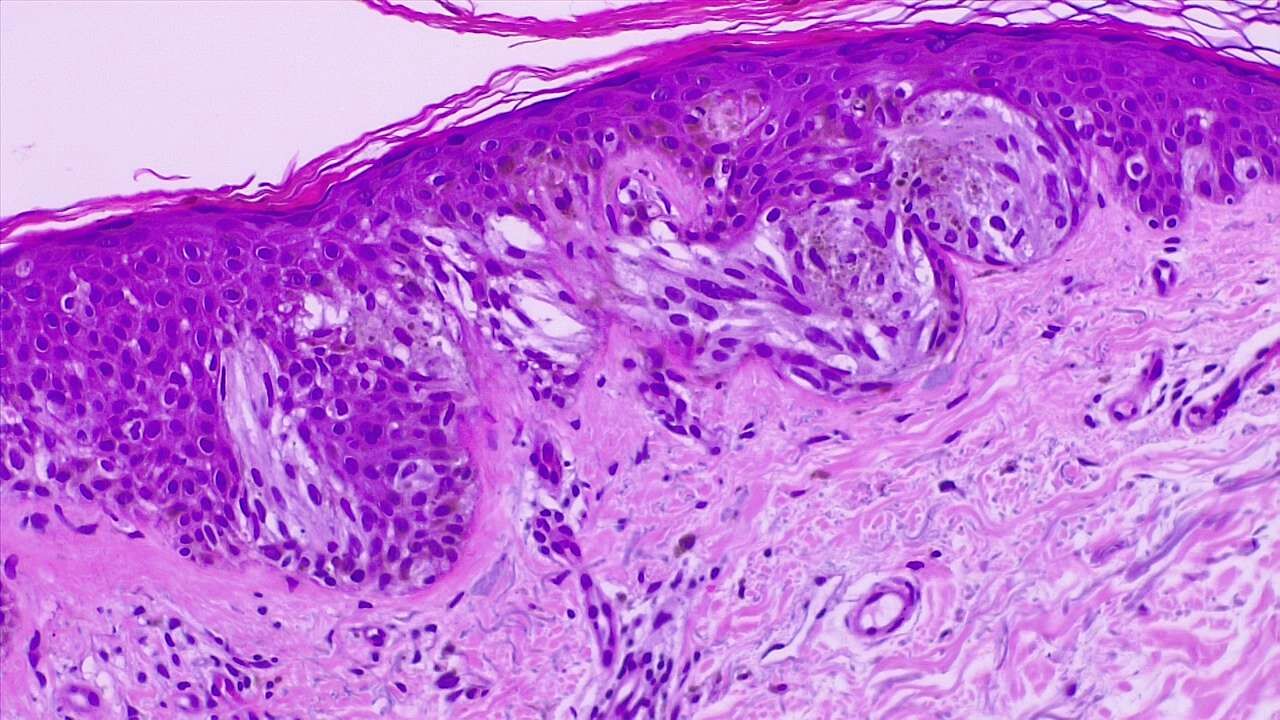 <p>Malignant Melanoma of the Skin. Epidermal invasion by atypical melanocytes, fused nests. H/E 4x.</p>