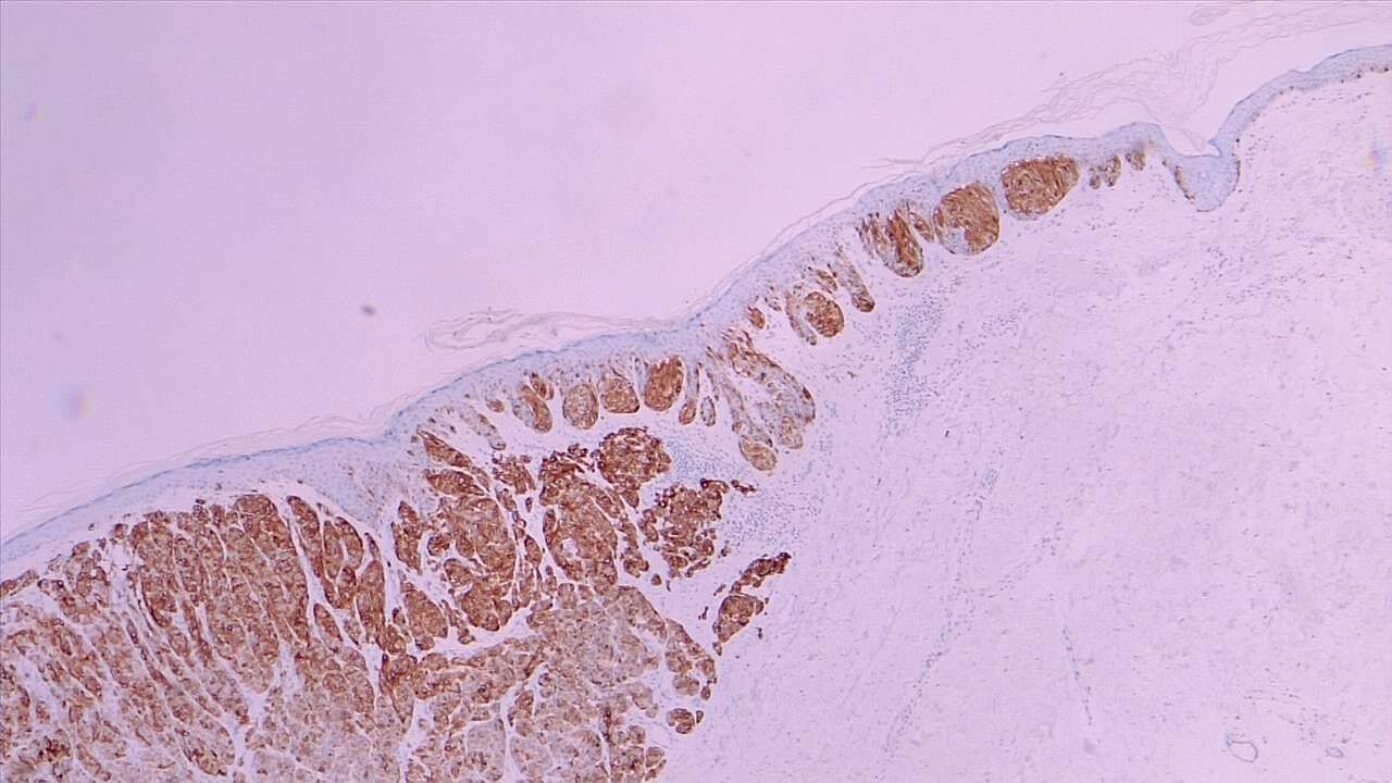 <p>Melanoma In Situ (Right Field) and Malignant Melanoma With Dermal Invasion. MART1 immunohistochemistry 4x.</p>