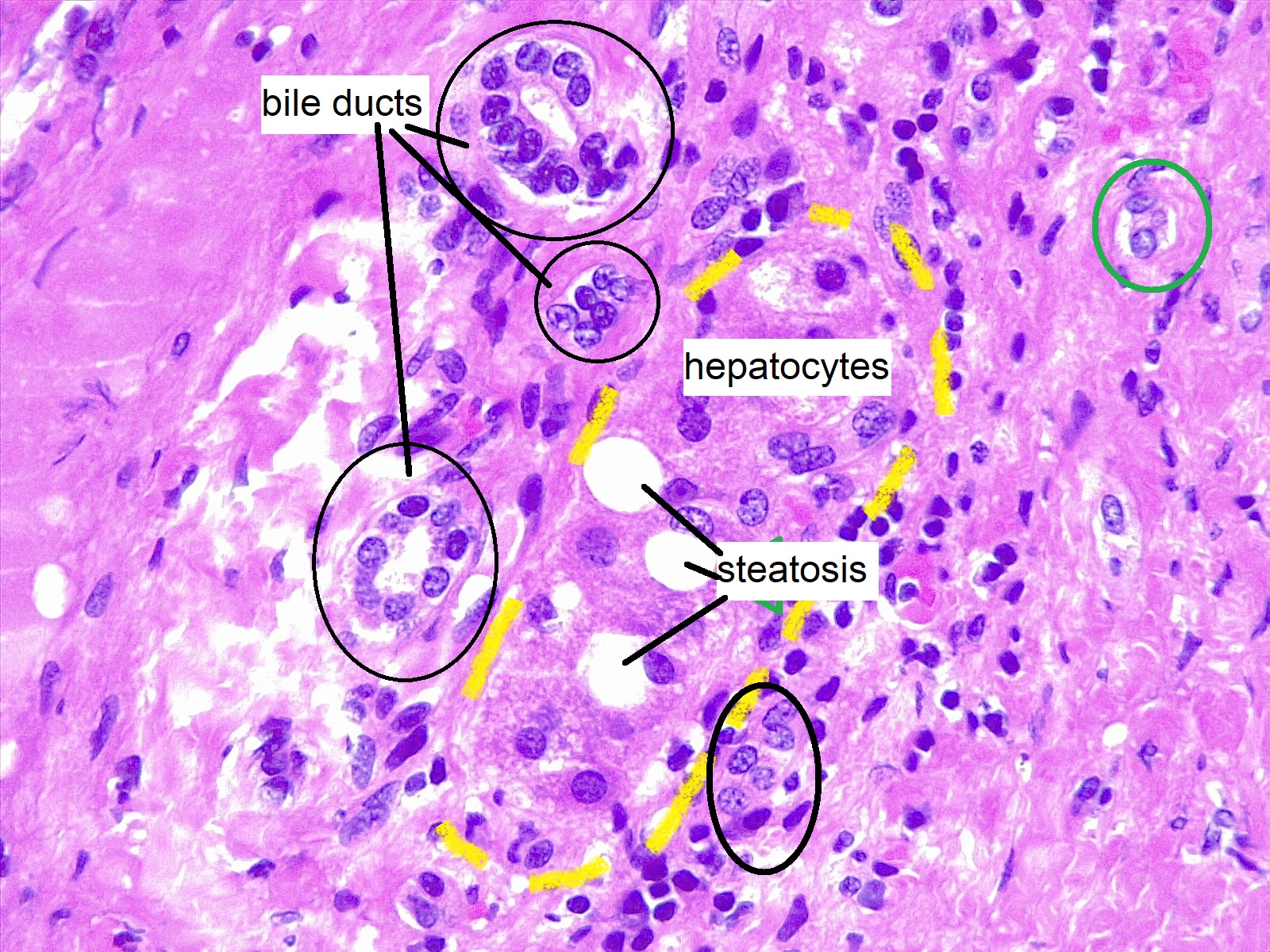Liver biopsy, hepatic steatosis