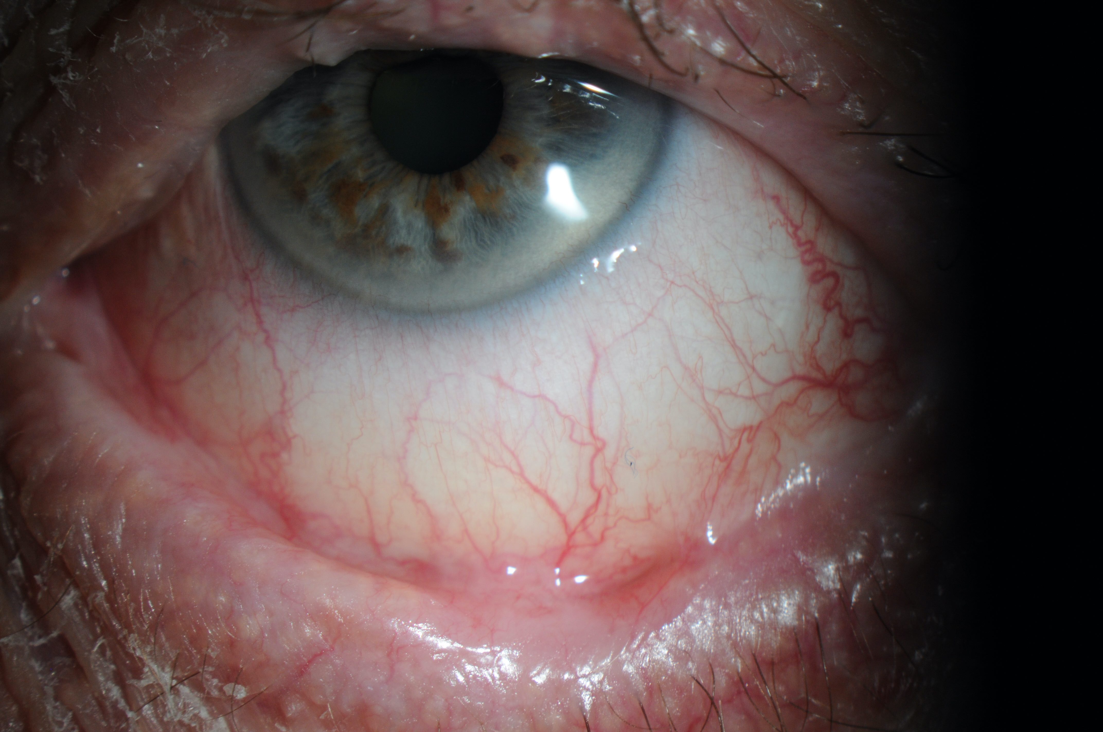 Atypical features such as chronic symptoms, relapsing/remitting course, and signs such as symblepharon, loss of the plica, shortening of conjunctival fornices suggest a non-viral cause of conjunctivitis