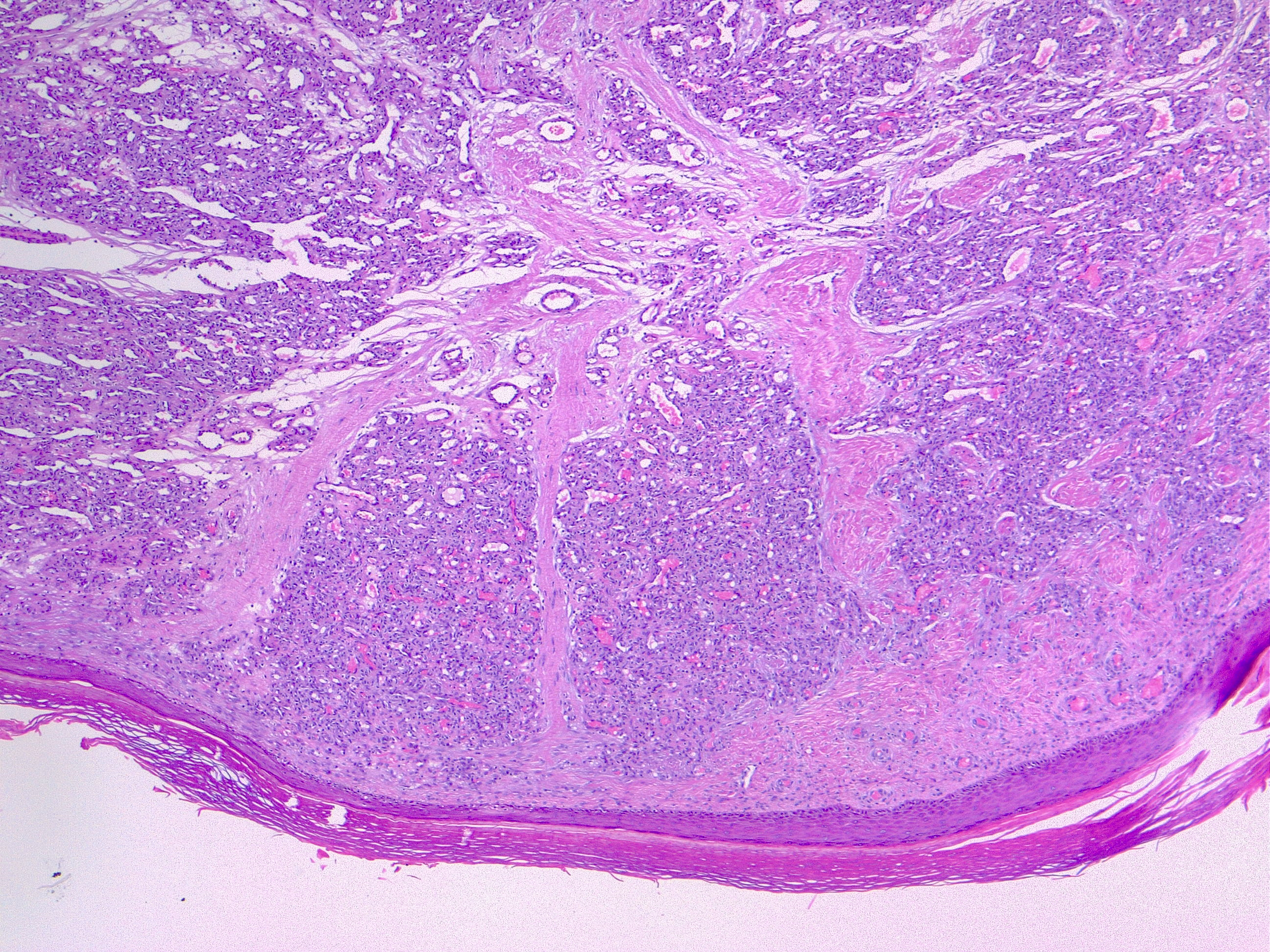 <p>Pyogenic Granuloma, H/E 4&times;. The lobular arrangement of the capillary vessels is a common feature.</p>
<p>&nbsp;</p>