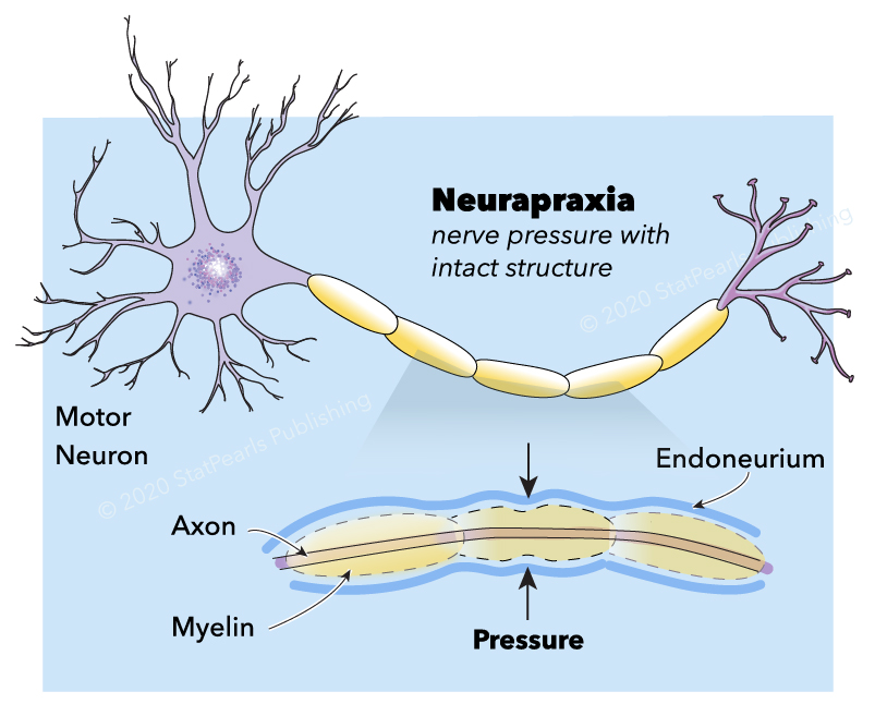 <p>Neurapraxia. Neurapraxia, motor neuron, axon, myelin, and endoneurium.</p>