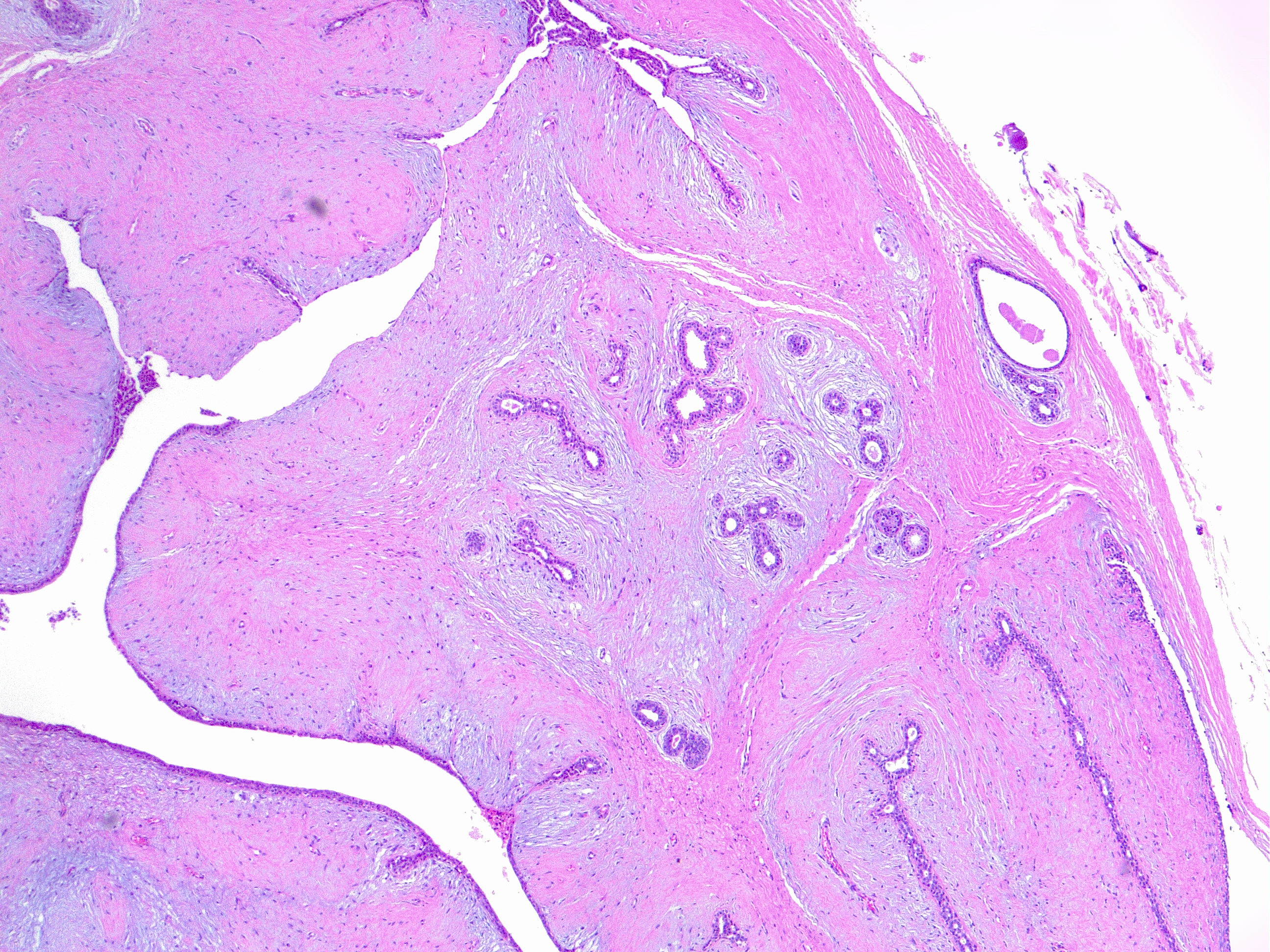 <p>Benign Phyllodes Tumor of the Breast. H/E 4&times;</p>