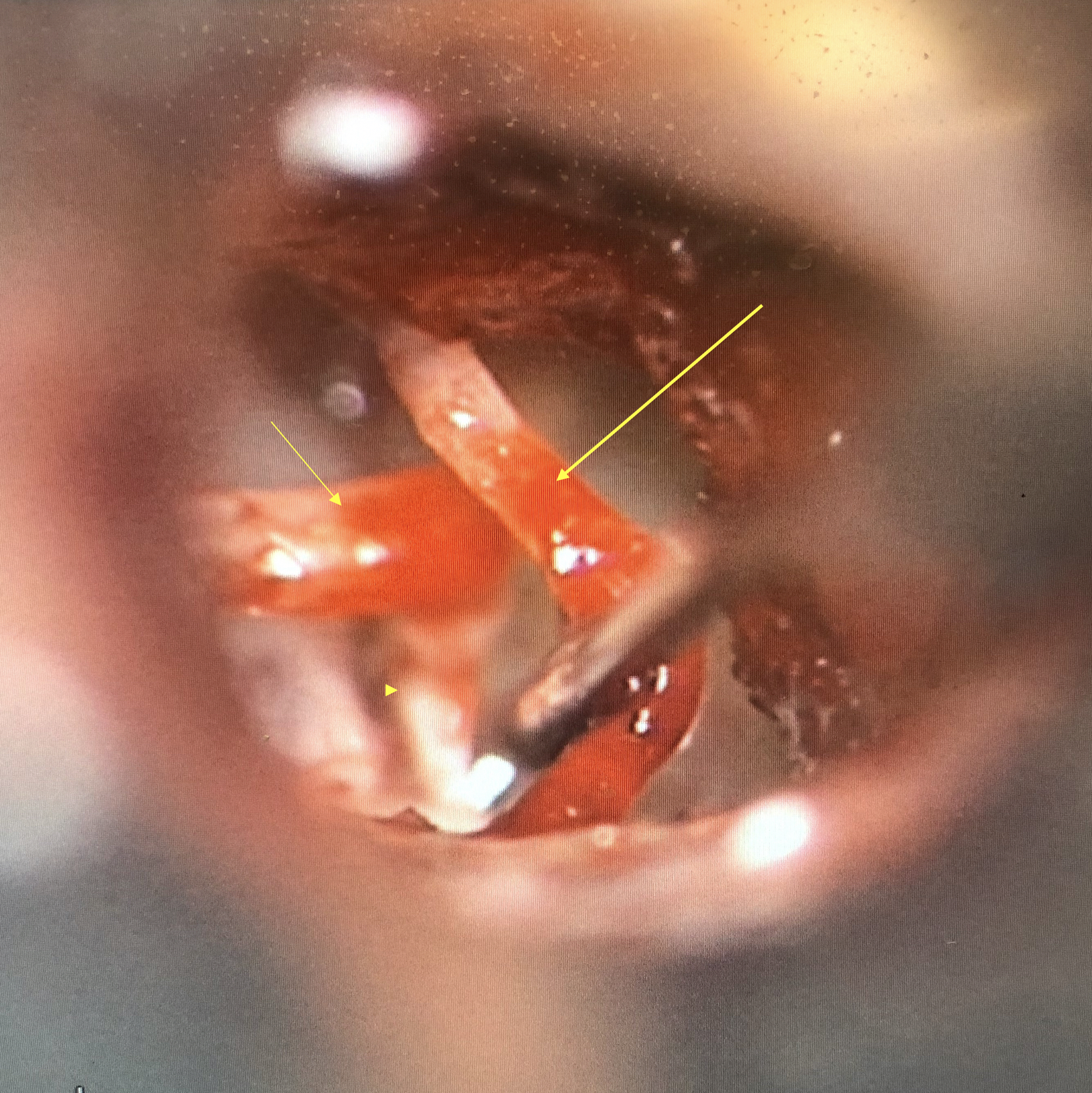 <p>Incudostapedial Joint, Intraoperative View
