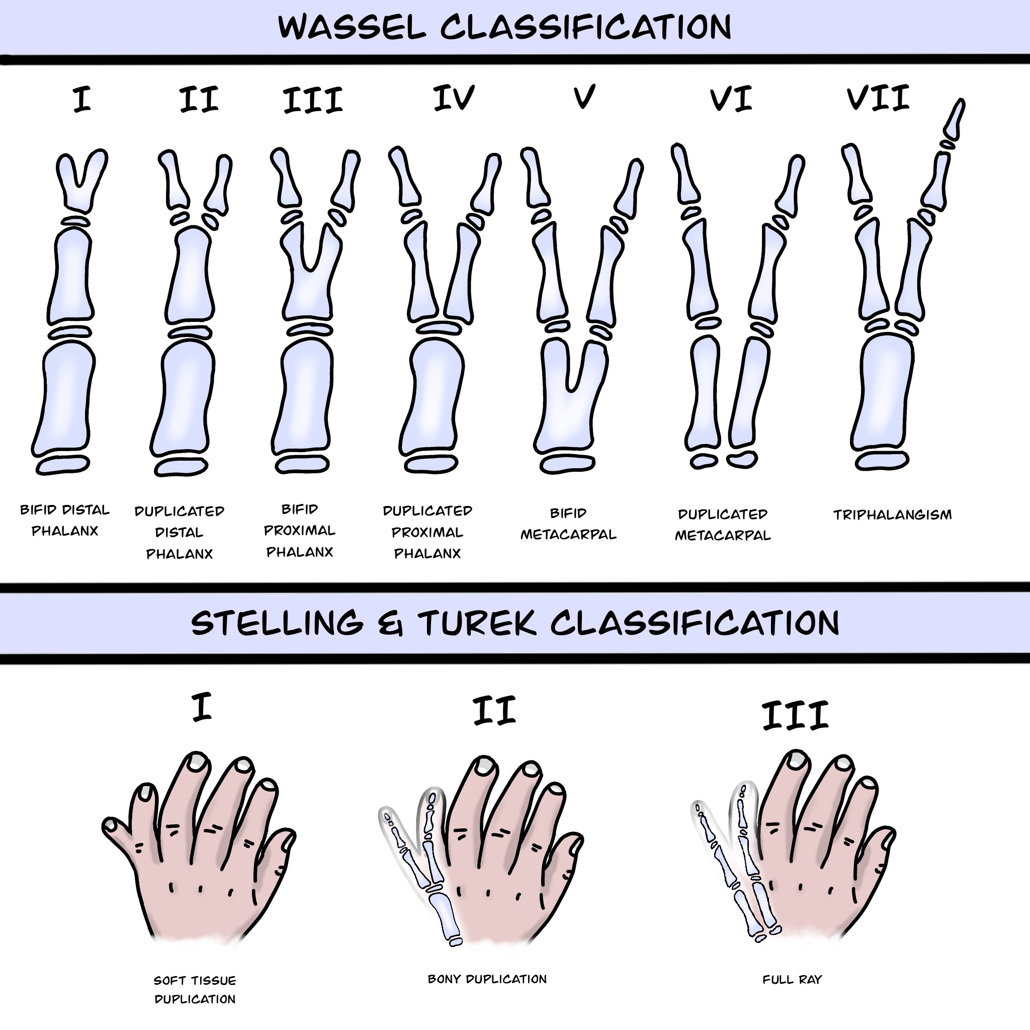 <p>Polydactyly Classifications
