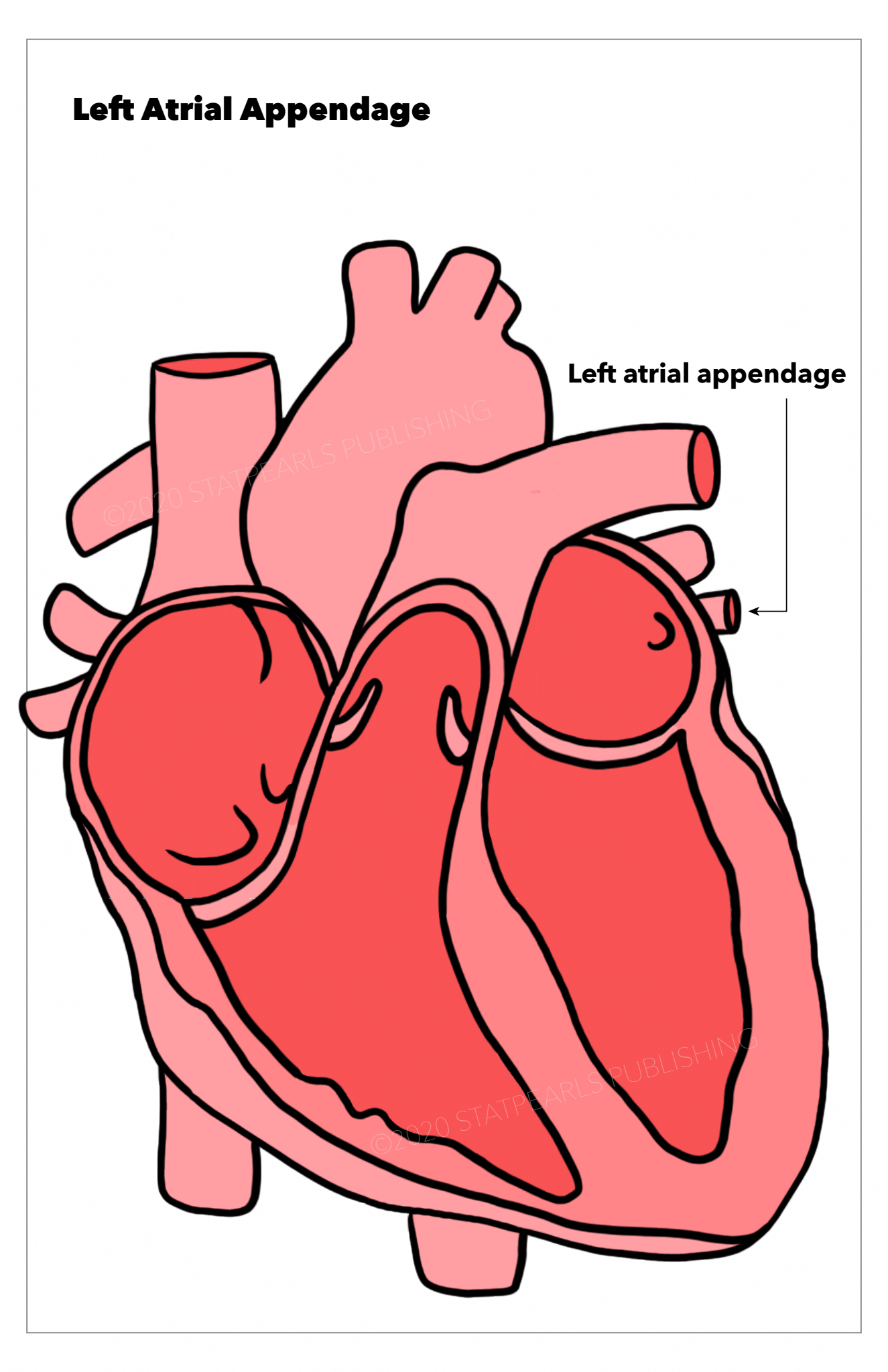 Left atrial appendage, heart