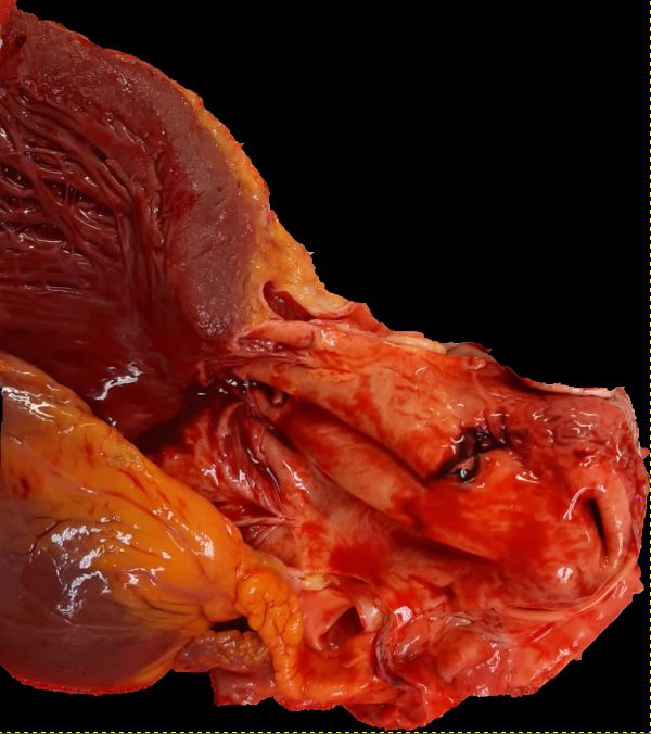 The ascending aorta presents a dissection a few centimeters above the aortic valve