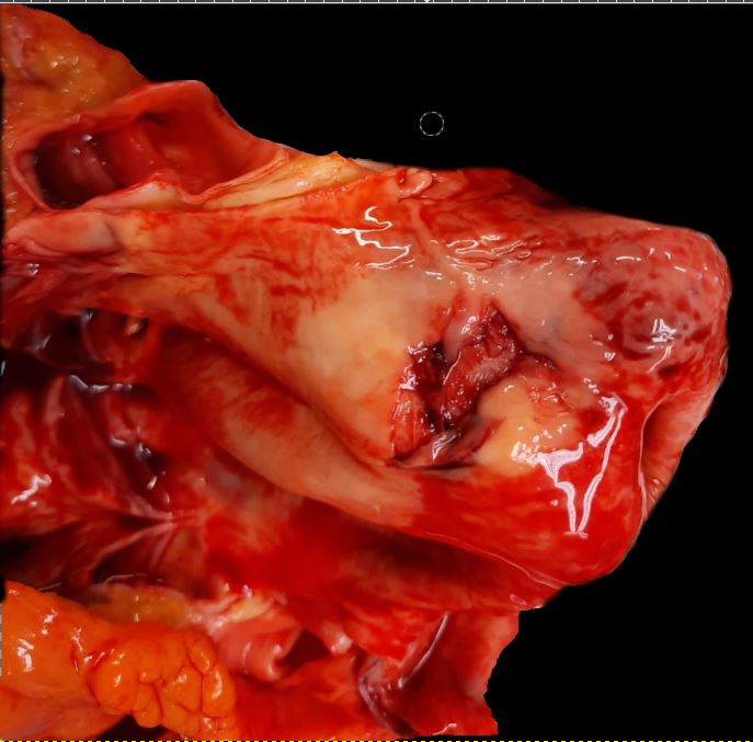 The ascending aorta presents a dissection a few centimeters above the aortic valve