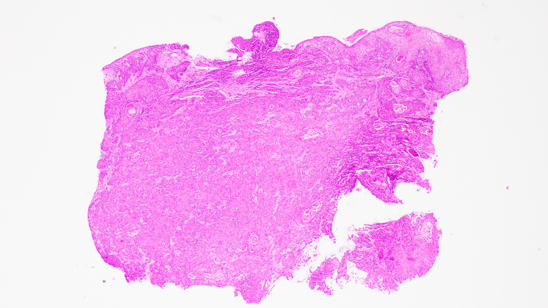 Histopathology slide of Vulvar Squamous cell Carcinoma, Low power field, H&amp;E stain.
