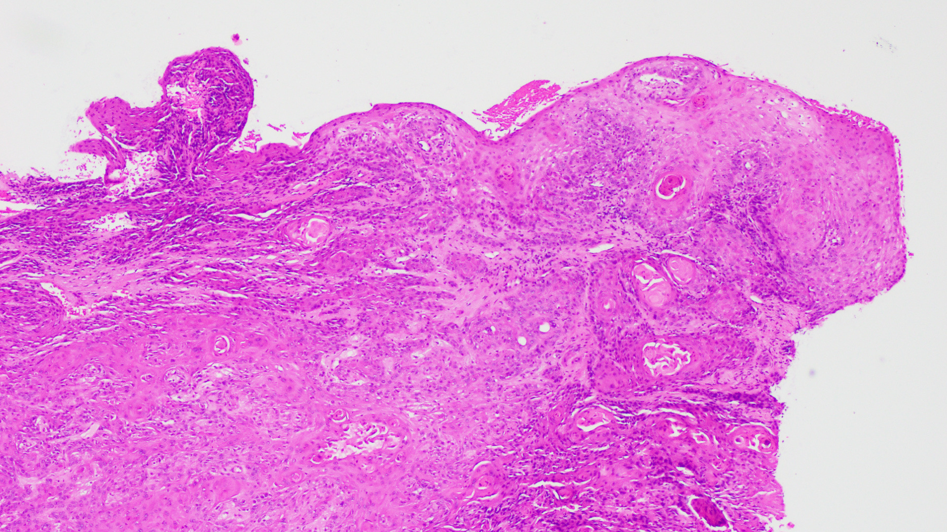 Histopathology Image of Vulvar Squamous Cell Carcinoma Low Power Field, H&amp;E stain, showing keratinized pearls.