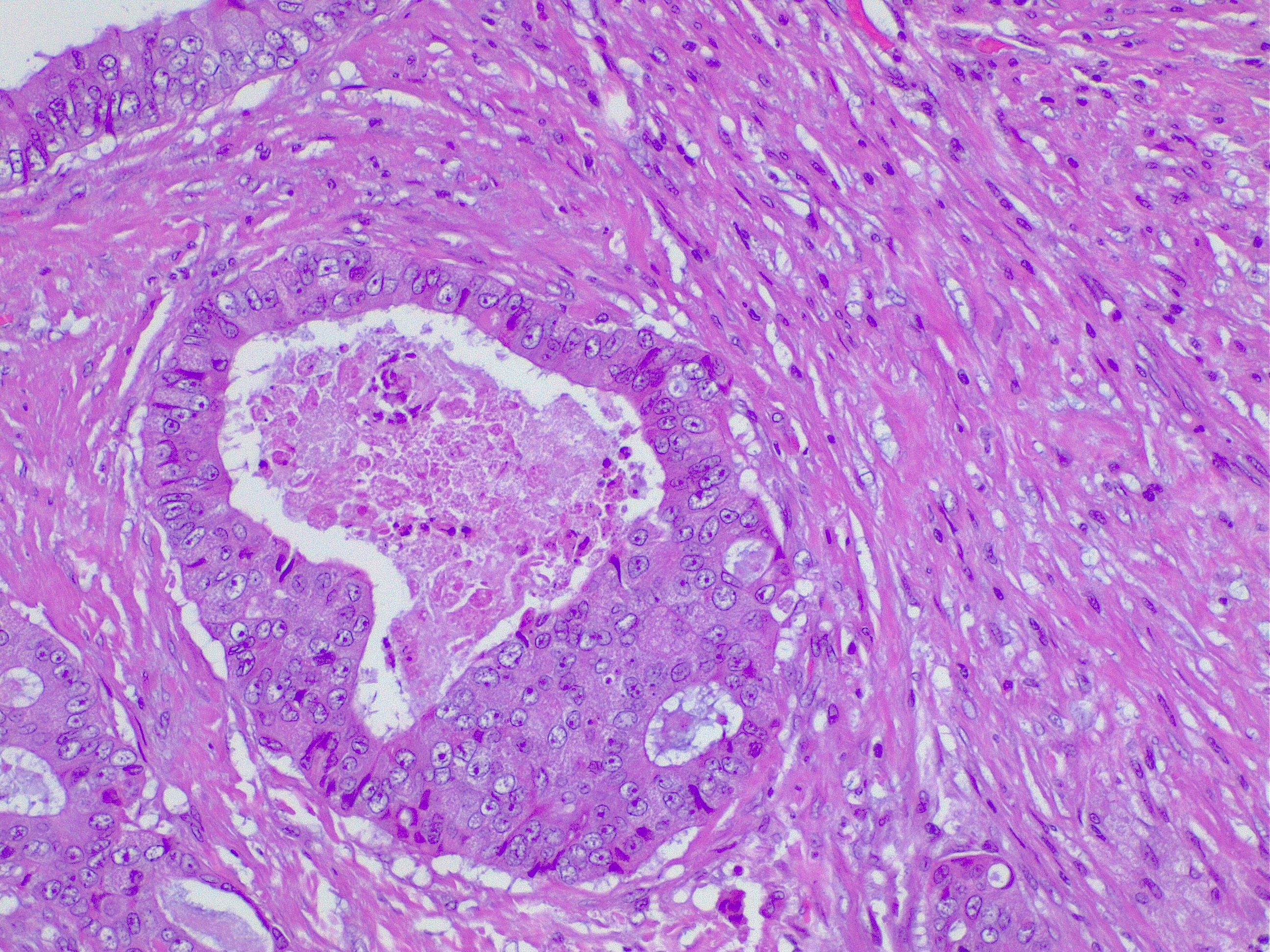 Adenocarcinoma. Central comedonecrosis: necrotic debris inside the neoplastic gland.