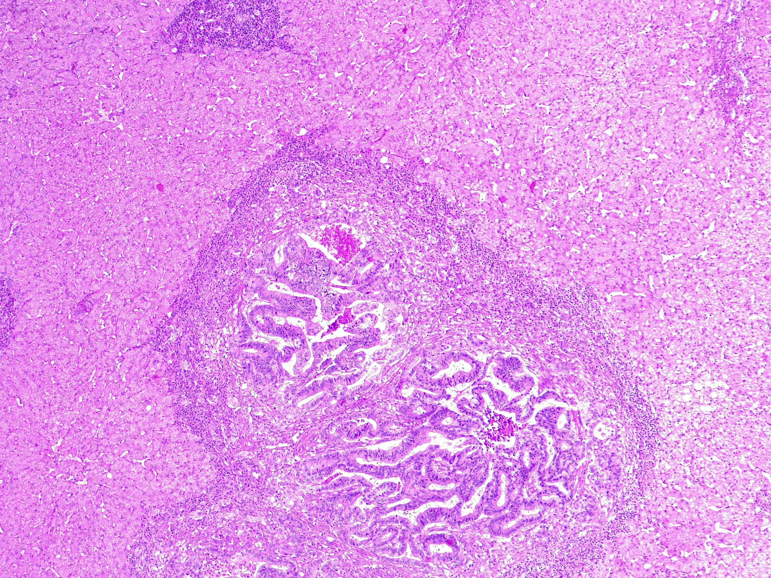 <p>Liver Metastasis in Colorectal Cancer