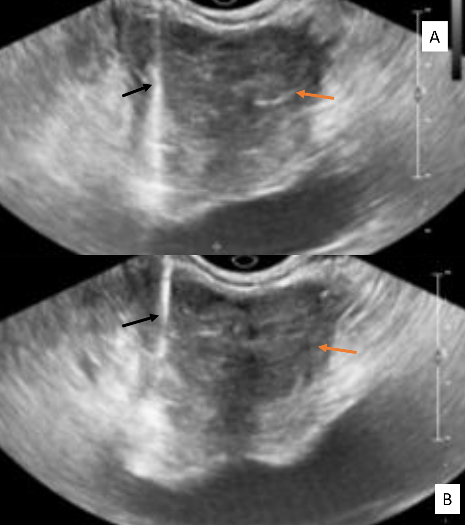 <p>Transrectal Ultrasound Guided Biopsy of the Prostate