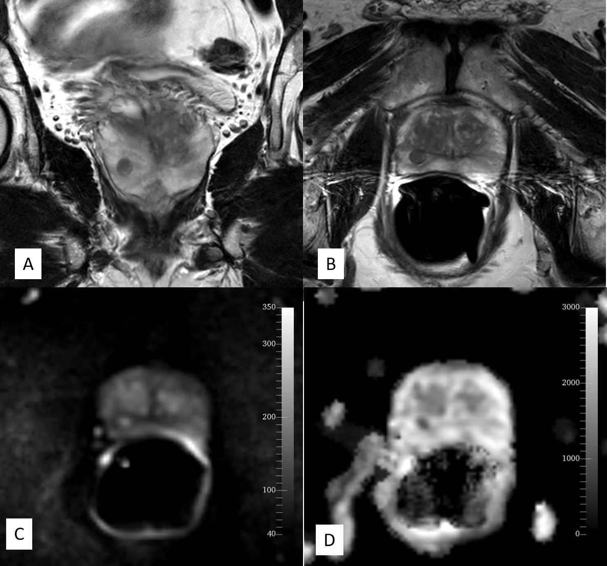 <p>MRI of Normal Prostate Using Endorectal Coil