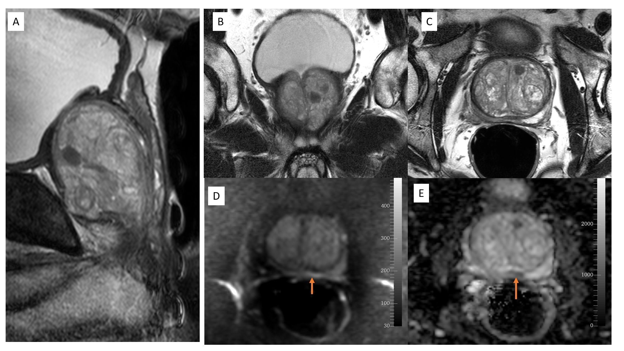 <p>MRI Prostate, PIRADS-2