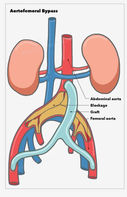 Aortofemoral bypass, abdominal aorta, blockage, graft, femoral aorta