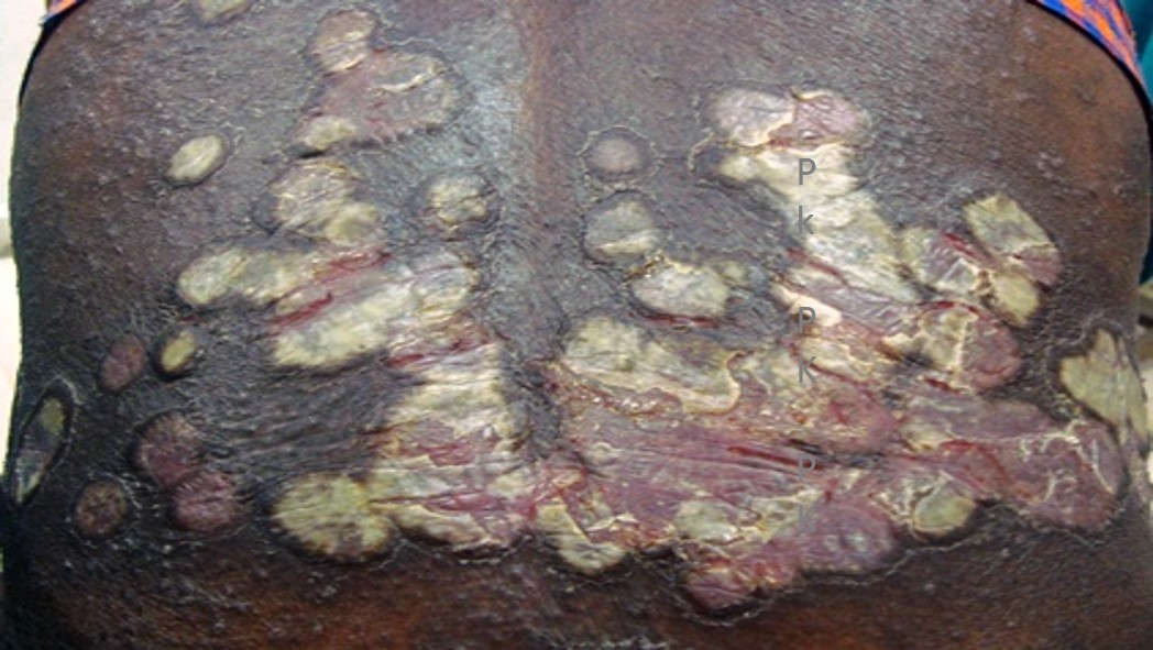 <p>Erythematous Scaly Plaques of Psoriasis. Plaques across lower back note the silvery white scales and fissures.</p>