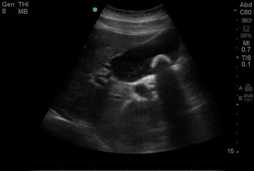 <p>Gallstone on Point-of-Care Ultrasound</p>