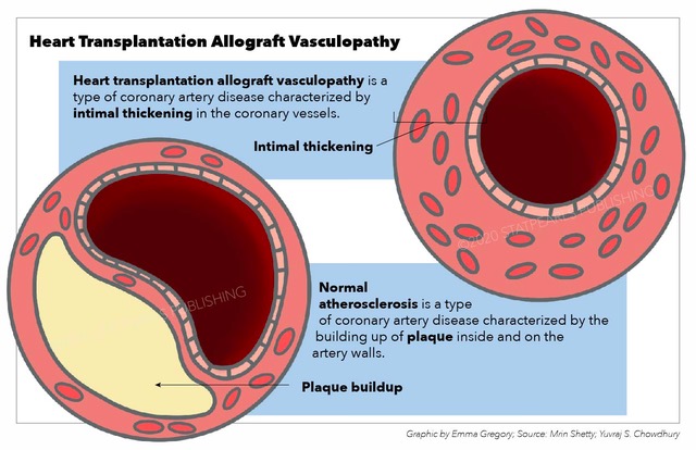 Heart Transplantation Allograft Vasculopathy, heart transplantation, vasculopathy, coronary artery disease, intimal thickenin