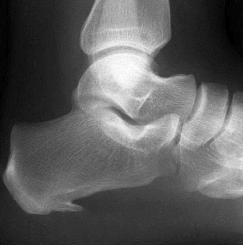 <p>Lateral Radiograph, Heel Spur. Heel spurs are present in approximately 50% of patients with plantar fasciitis.</p>