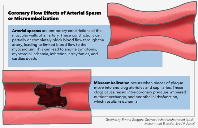 Coronary Flow Effects of Arterial Spasm or Microembolization, arterial spasm, blood flow, myocardium, plaque, clog, arteriole