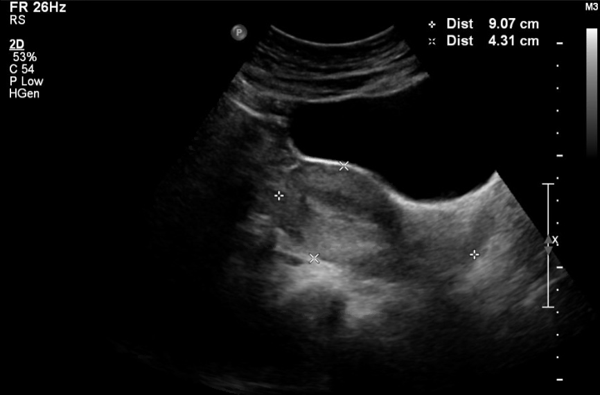 <p>Ultrasound Uterus Sagittal, Anteverted and Anteflexed Orientation