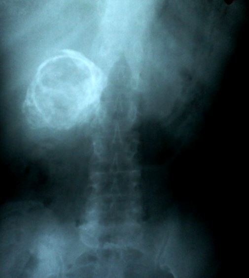 <p>Porcelain Gallbladder. This x-ray image demonstrates the inner gallbladder wall encrusted with calcium.</p>