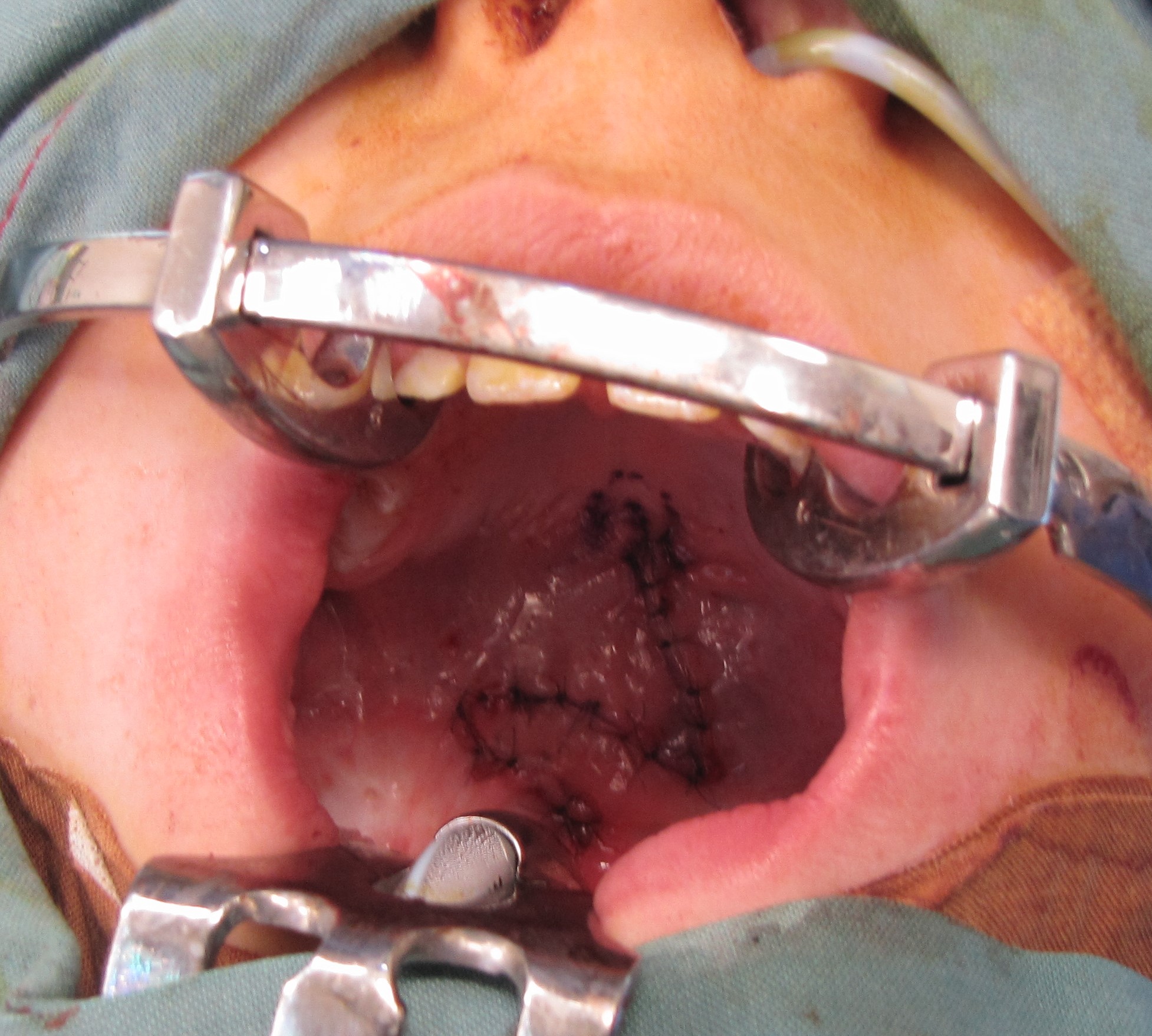 Operative view of a secondary cleft palate involving the soft palate, after repair following Furlow double opposing Z-plasty.