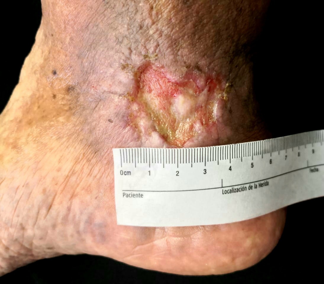 <p>Venous Leg Ulcer
