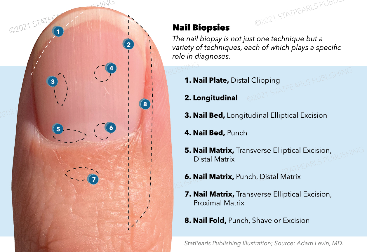 Nail biopsy, nail plate, longitudinal, nail bed, nail matrix, nail fold, punch, shave, excision, transverse elliptical excisi