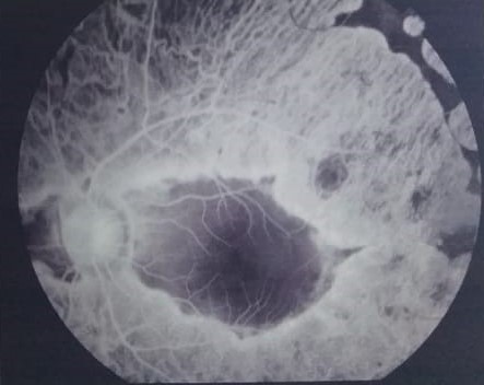 Fundus fluorescein angiography of a child with gyrate atrophy showing scalloped areas of retinal pigment epithelium and chori
