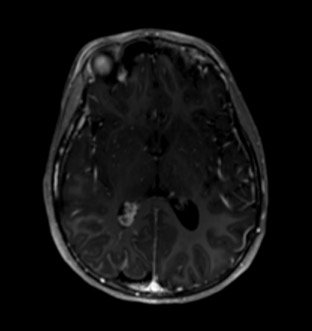 <p>Axial T1 Postcontrast Brain MRI. MRI demonstrates leptomeningeal enhancement and enlarged choroid plexus.</p>