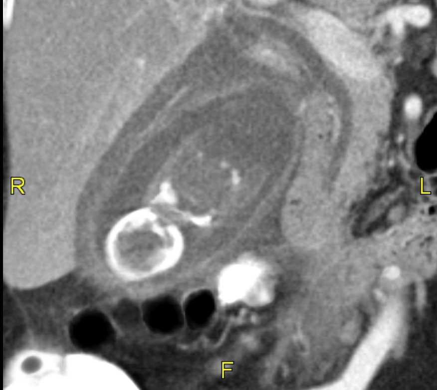 <p>CT Acute Cholecystitis Wall Thickening Pericholecystic Fluid Gallstone</p>