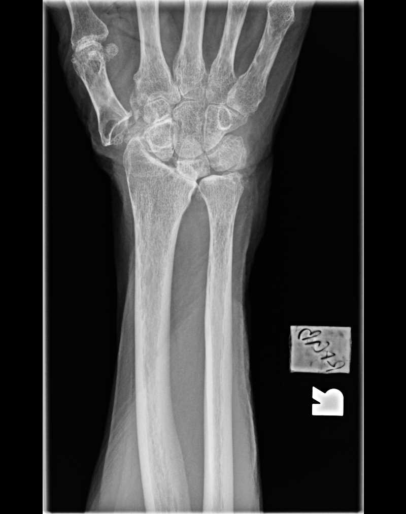 <p>Wrist Radiograph,&nbsp;Scapholunate Advanced Collapse (SLAC) Madelung Deformity</p>