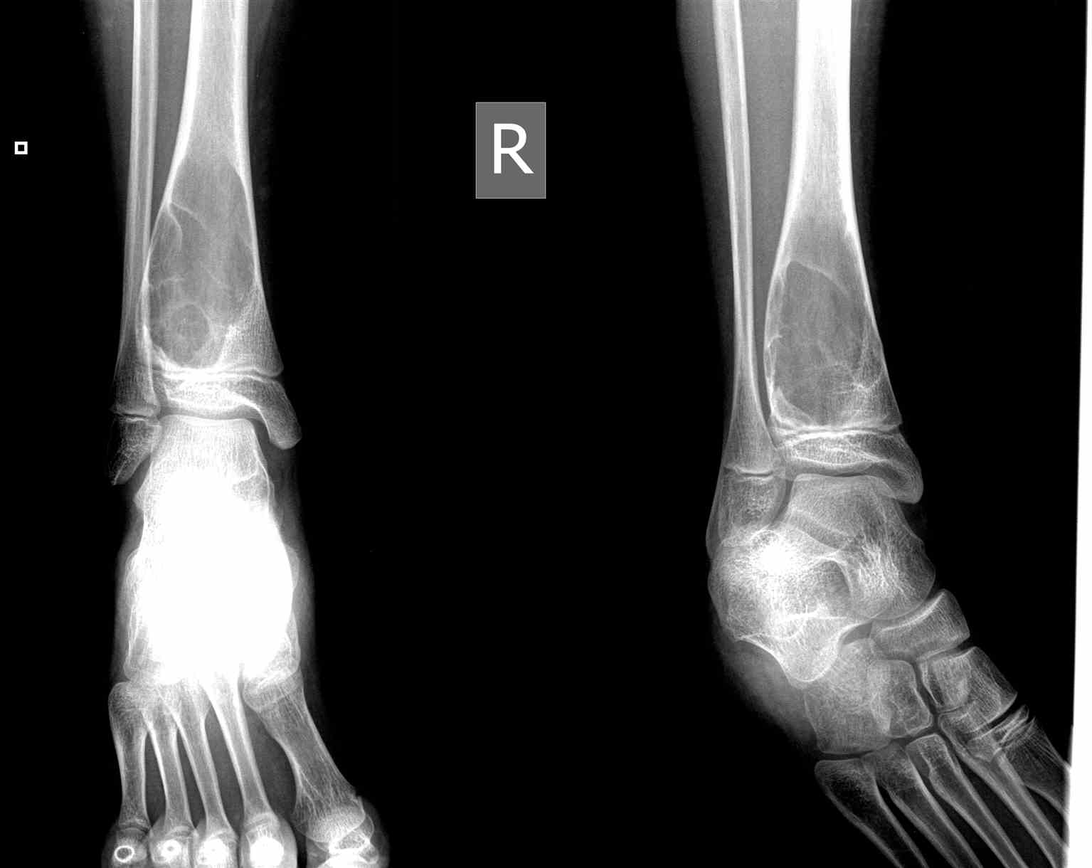 <p>Ankle Radiograph,&nbsp;Aneurysmal Bone Cyst (ABC)