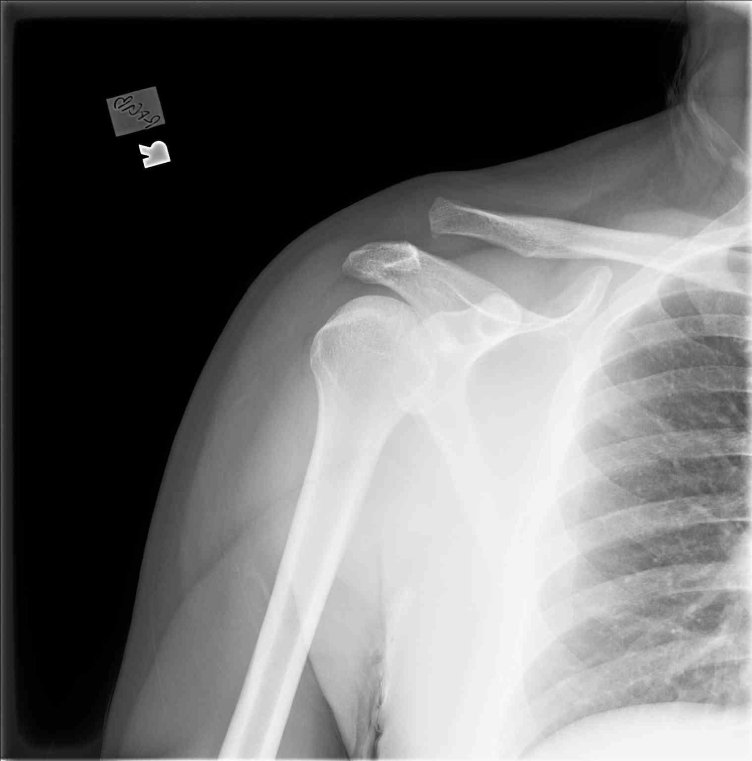<p>Shoulder Radiograph,&nbsp;Acromioclavicular (AC) Joint Separation With Injury Type III/IV</p>