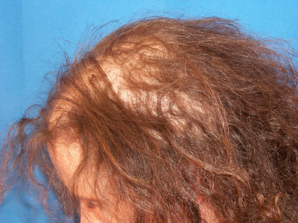 <p>Anagen Effluvium. The image shows the shedding of structurally damaged hairs resulting in diffuse alopecia.</p>