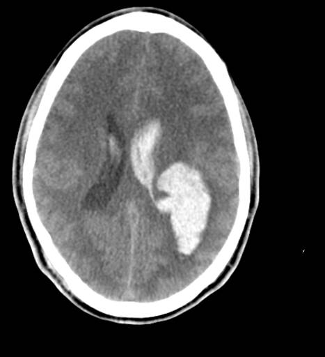 <p>Head CT,&nbsp;Intraventricular and Intraparenchymal Hemorrhage From Arteriovenous Malformations (AVM)</p>