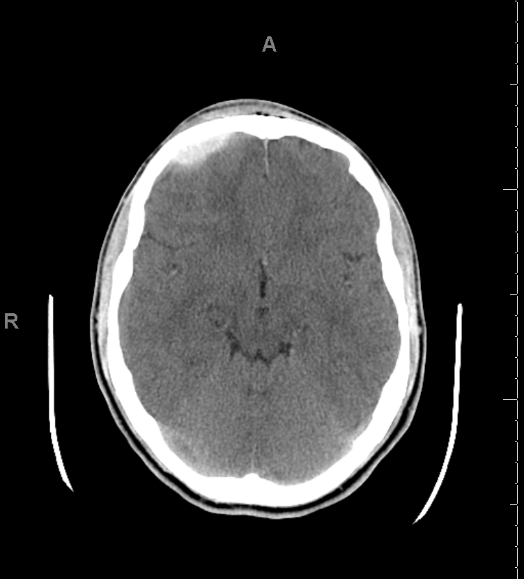 <p>Head CT,&nbsp;Epidural Hematoma</p>