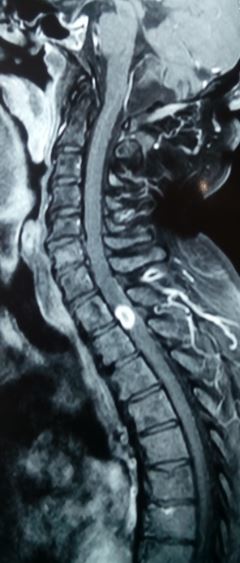 <p>Spinal Cord Tuberculoma</p>