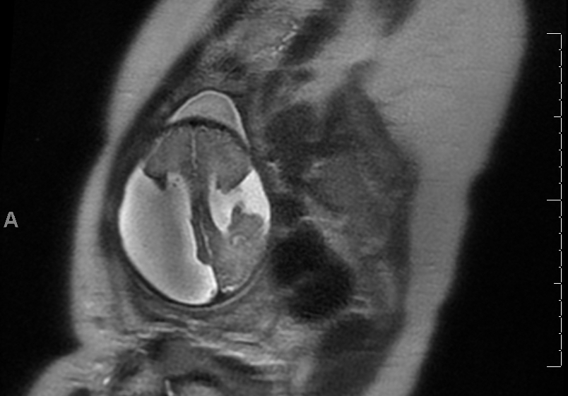 <p>Maternal MRI, Bilateral Open Lip Schizencephaly</p>