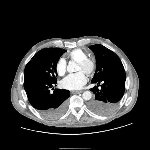 <p>Bilateral Pleural Effusions on Chest Computed Tomography