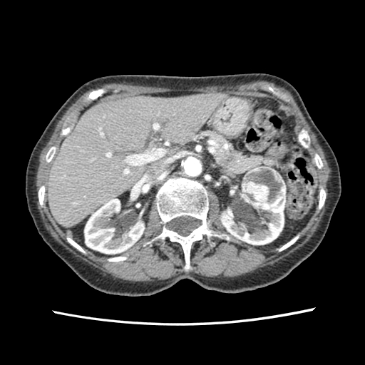 <p>Abdomen CT, Bosniak IV Left Renal Cell Lesion Consistent With Renal Cell Carcinoma</p>