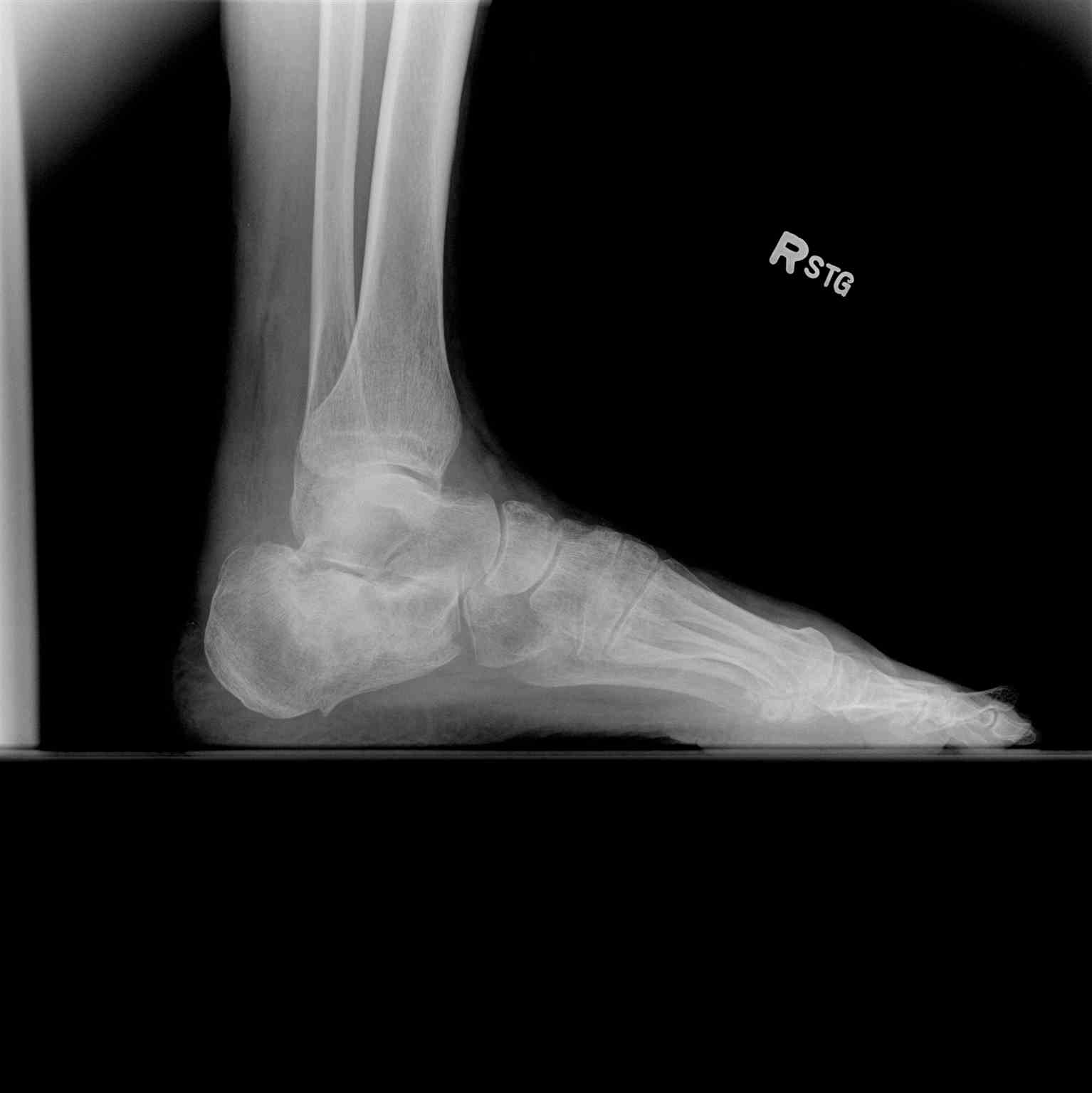 <p>Ankle Radiograph, Lateral Calcaneus Fracture</p>